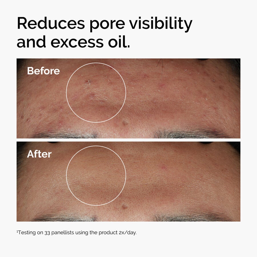 niacinamide-10-zinc-1-e3 ord-niacinamide-zinc-blemish-serum-before-after-pores.jpg