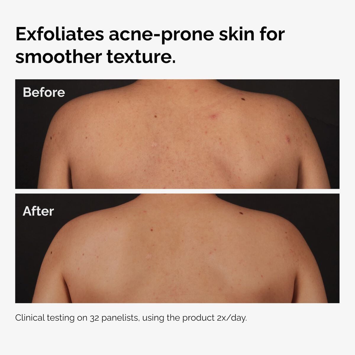 salicylic-acid-0-5-body-serum-x6 ord-salicylic-acid-body-serum-before-after-graphic-NA.jpg